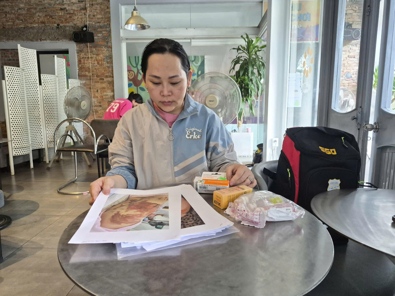 Sau sự cố bỏng phải điều trị kéo dài, kế hoạch trở về nước của người phụ nữ bị ảnh hưởng.