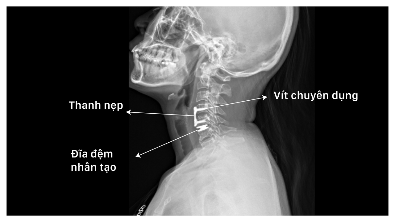 Đĩa đệm nhân tạo và hệ thống nẹp vít được các bác sĩ kiểm tra bằng X-quang sau phẫu thuật. (Ảnh: BVCC)