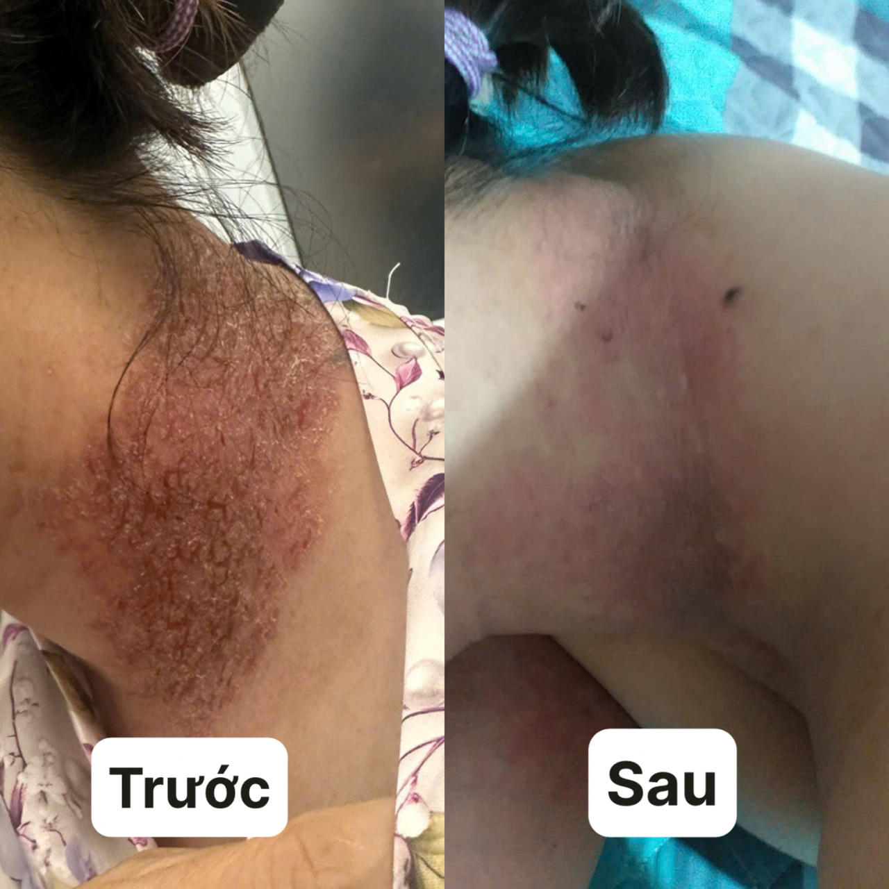 Các vùng da ở nếp gấp bị trợt loét, rỉ dịch kéo dài khiến người bệnh phải chịu đựng đau đớn suốt nhiều năm. Ảnh: Thanh Thanh