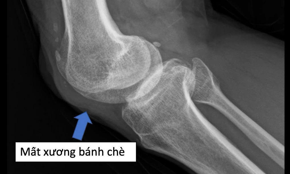 Hình ảnh X-Quang đầu gối người bệnh không còn xương bánh chè.