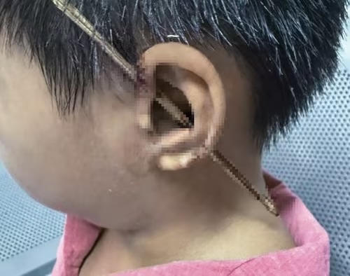 Bệnh nhi H.M.V bị que tre đâm xuyên vành tai trái. (Ảnh: Bệnh viện cung cấp)