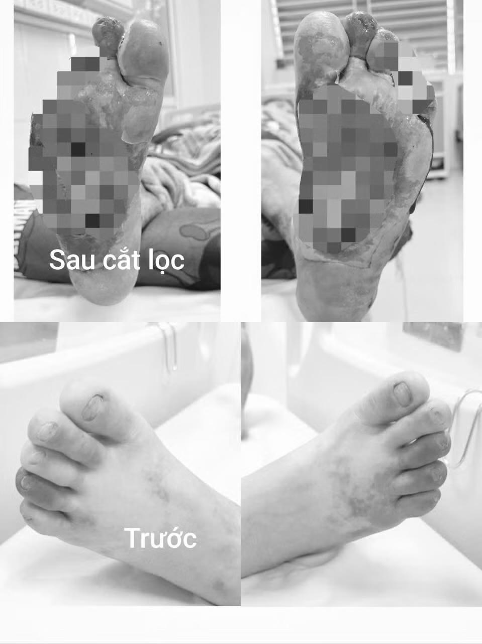 Mất nhiều đốt ngón chân vì chủ quan với vết xước nhỏ. Ảnh: Thanh Thanh