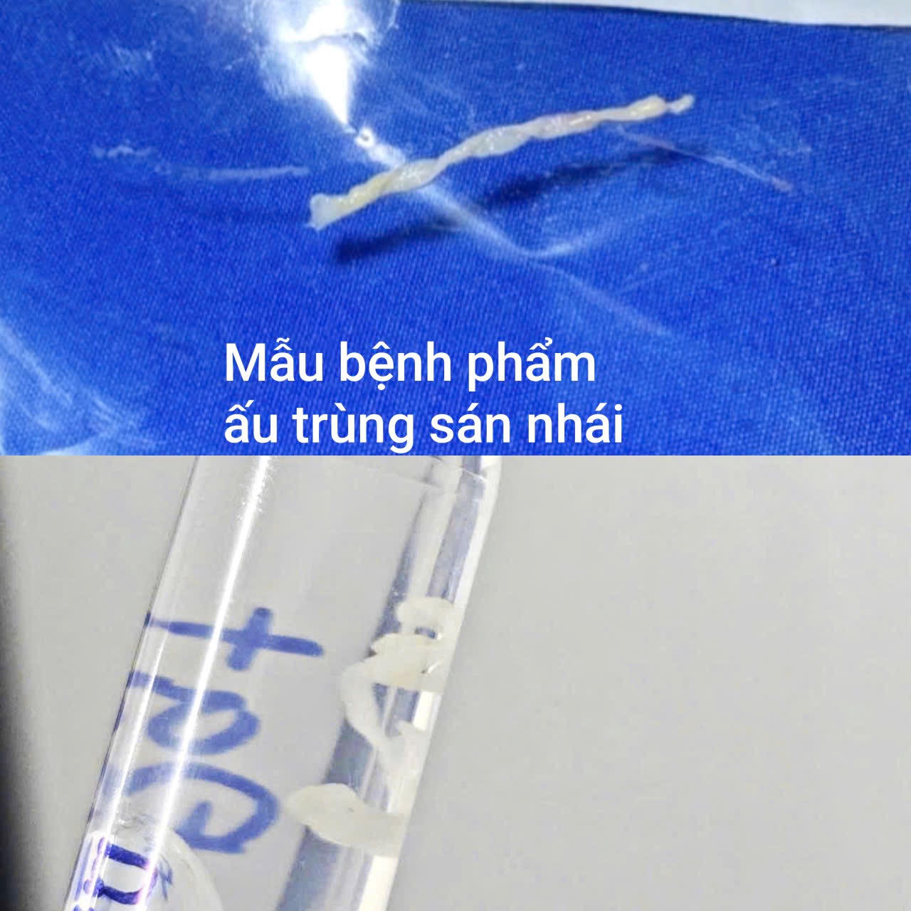 Mẫu bệnh phẩm ấu trùng sán nhái. Ảnh: BVCC