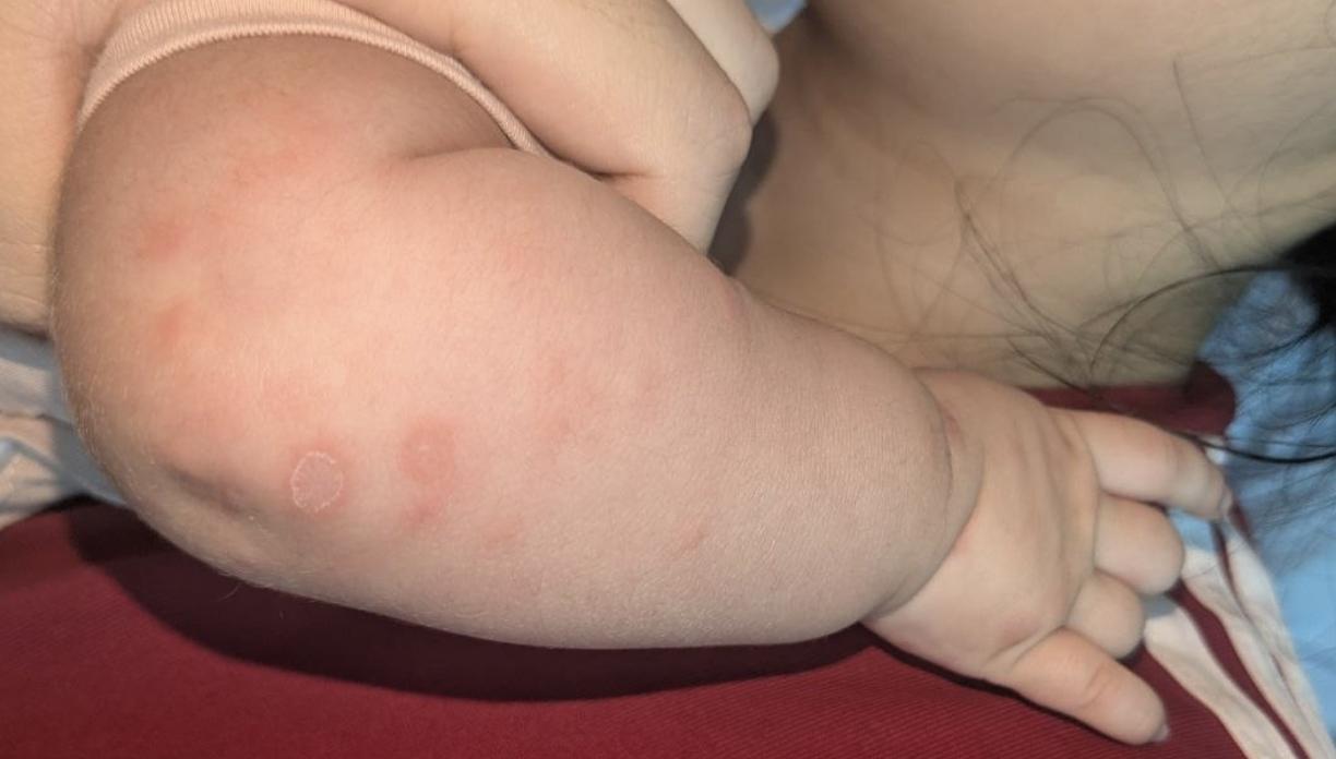 Bé gái 2 tháng tuổi bị giang mai bẩm sinh, bác sĩ cảnh báo các 'mẹ bầu' Bé gái 2 tháng tuổi bị giang mai bẩm sinh, bác sĩ cảnh báo các 'mẹ bầu'