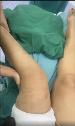‘Hồi sinh’ khớp gối đứt 3 dây chằng sau tai nạn giao thông 