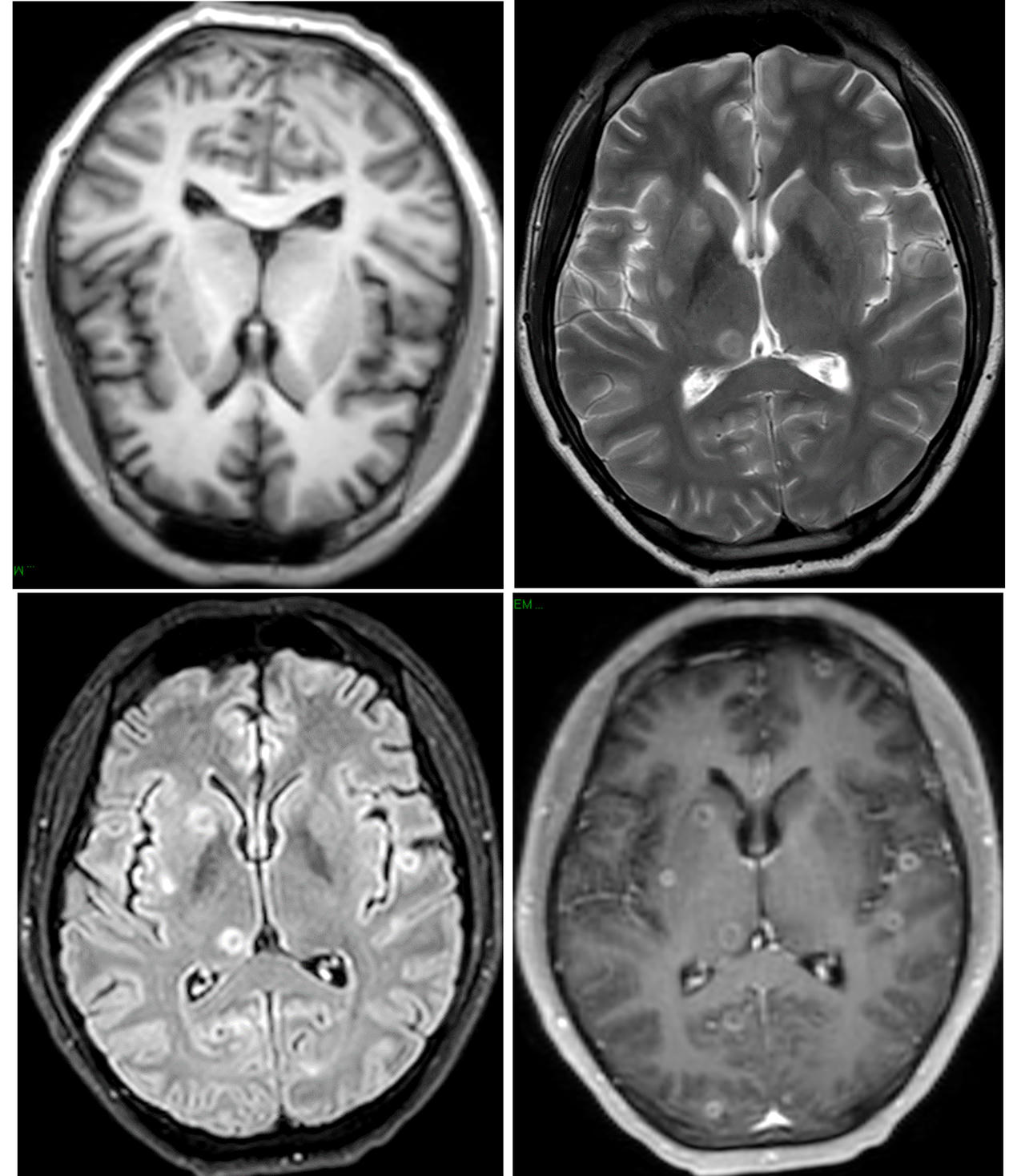 Hình ảnh MRI sọ não của bệnh nhân T. bị nhiều tổn thương dạng nốt (Ảnh: BVĐKTV).