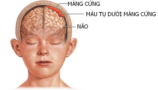 Trung tâm Y tế huyện Cẩm Khê phẫu thuật thành công ca lấy máu tụ dưới màng cứng.