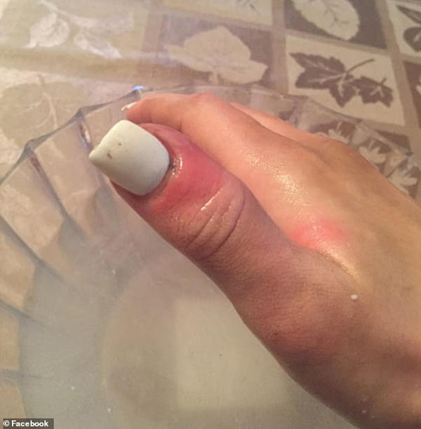 Hoa hậu 21 tuổi phát hiện ung thư nhờ dấu hiệu trên ngón tay