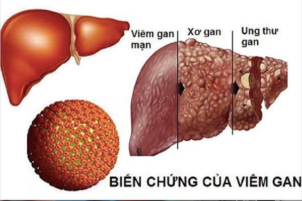 Viêm gan B và con số giật mình