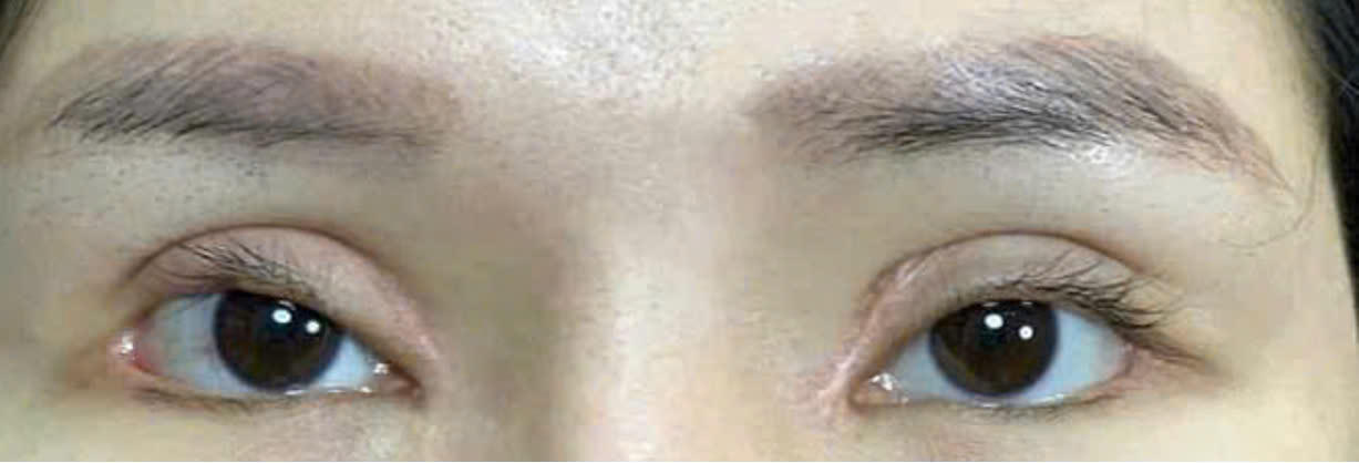 Chuyên gia chia sẻ 4 cách giúp chị em tránh khỏi những tai biến sau khi làm đẹp mắt