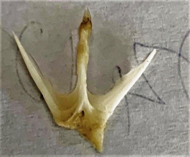 Gắp xương cá 4 chấu đâm sâu vào thành thực quản cho một bệnh nhi