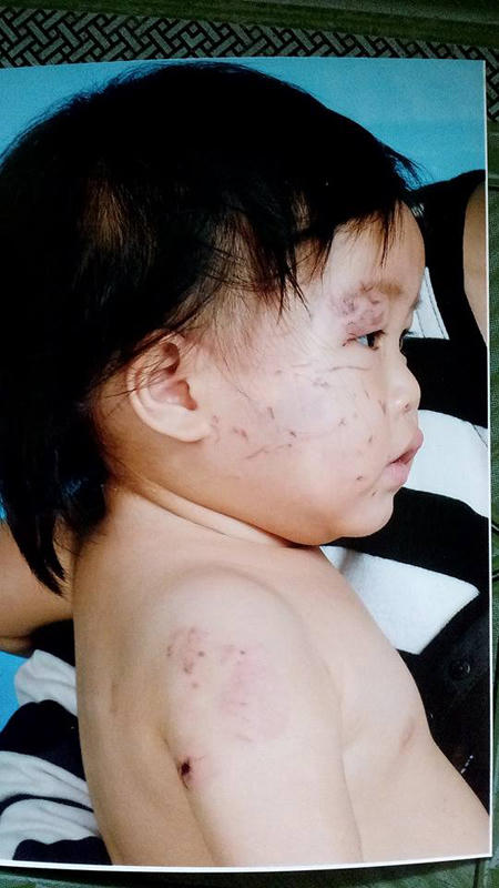 Bé 11 tháng bị “bầm dập” ở nhà trẻ, gia đình báo cáo lên chính quyền