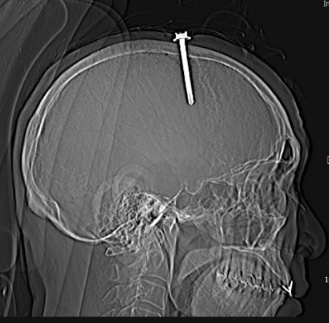 Người đàn ông tự đóng đinh vào đầu 