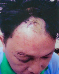 Đánh người gây thương tích vẫn nhởn nhơ ngoài vòng pháp luật