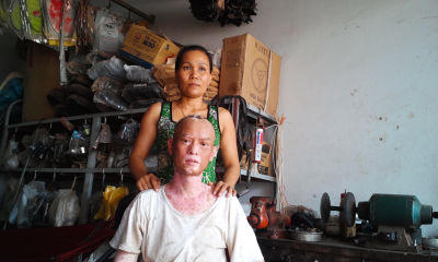 Chuyện tình cổ tích của người đàn ông mắc căn bệnh “quỷ ám”