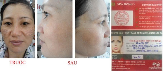 Hãy đừng bi quan khi bạn bị bệnh nám da nhé!