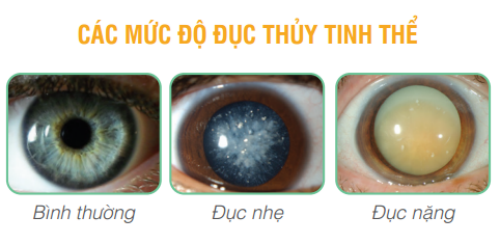 Mù mắt vì... ghét đến bệnh viện