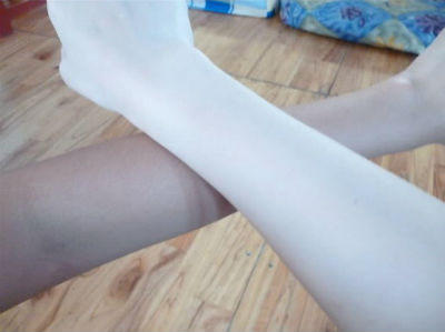 Hãi hùng sự thật về kem trắng da siêu tốc