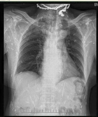 Rùng mình trước hình X - quang của người mê... ăn sống