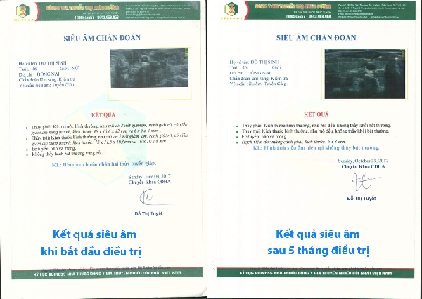 Niềm vui sướng của chị thợ may "thoát" 4 khối u tuyến giáp sau 150 ngày