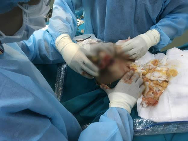 Nữ việt Kiều suýt hỏng ngực sau 3 năm tiêm silicon