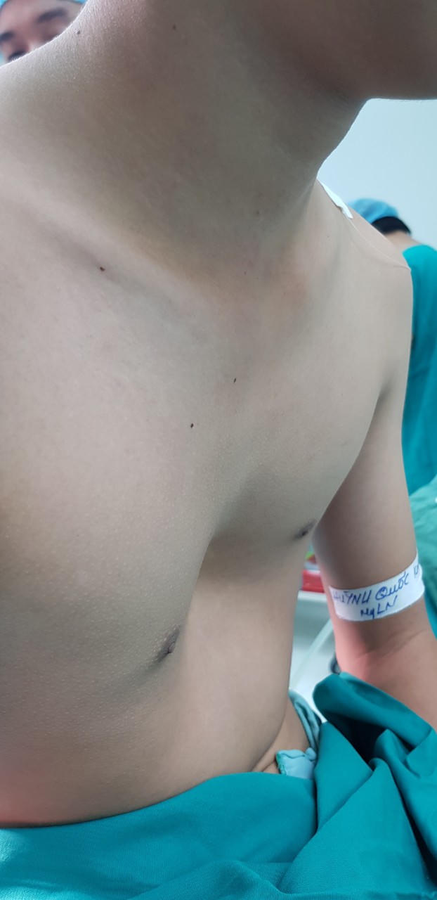 Liệu pháp đột phá “cứu cánh” cho bệnh nhân bị lõm ngực