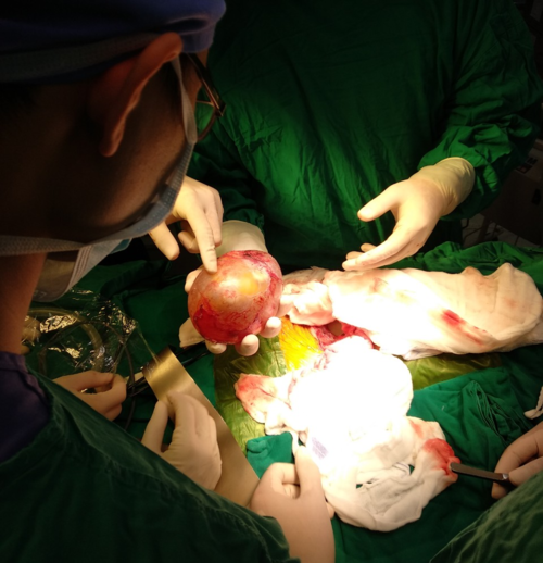 Bác sĩ phẫu thuật mang khối u thai ra ngoài. Ảnh bệnh viện cung cấp.