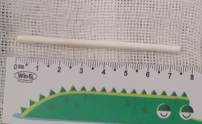 Dị vật là que kẹo mút được lấy ra khỏi đường tiêu hoá củabé trai. Ảnh bệnh viện cung cấp.