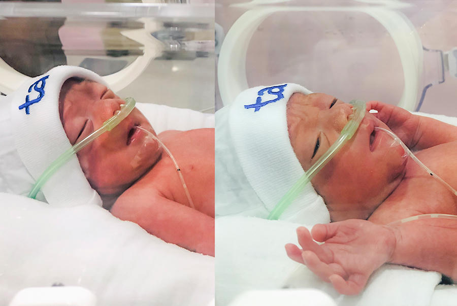 Bệnh viện Đa Khoa Tâm Anh mổ cấp cứu thành công song thai “tam tai” hiếm gặp