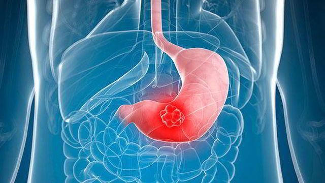 Cô gái 21 tuổi đã bị ung thư, bác sĩ cảnh báo thói quen xấu ở giới trẻ