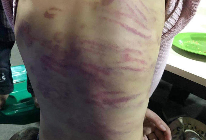 Bé gái bị mẹ bạo hành dã man, “dượng hờ” xâm hại: Dấu hiệu thiếu trách nhiệm của chính quyền địa phương