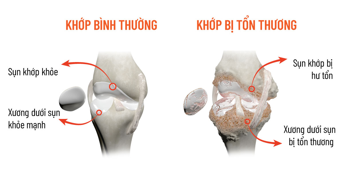 Rối loạn miễn dịch, bão cytokine khiến xương khớp đau nhức