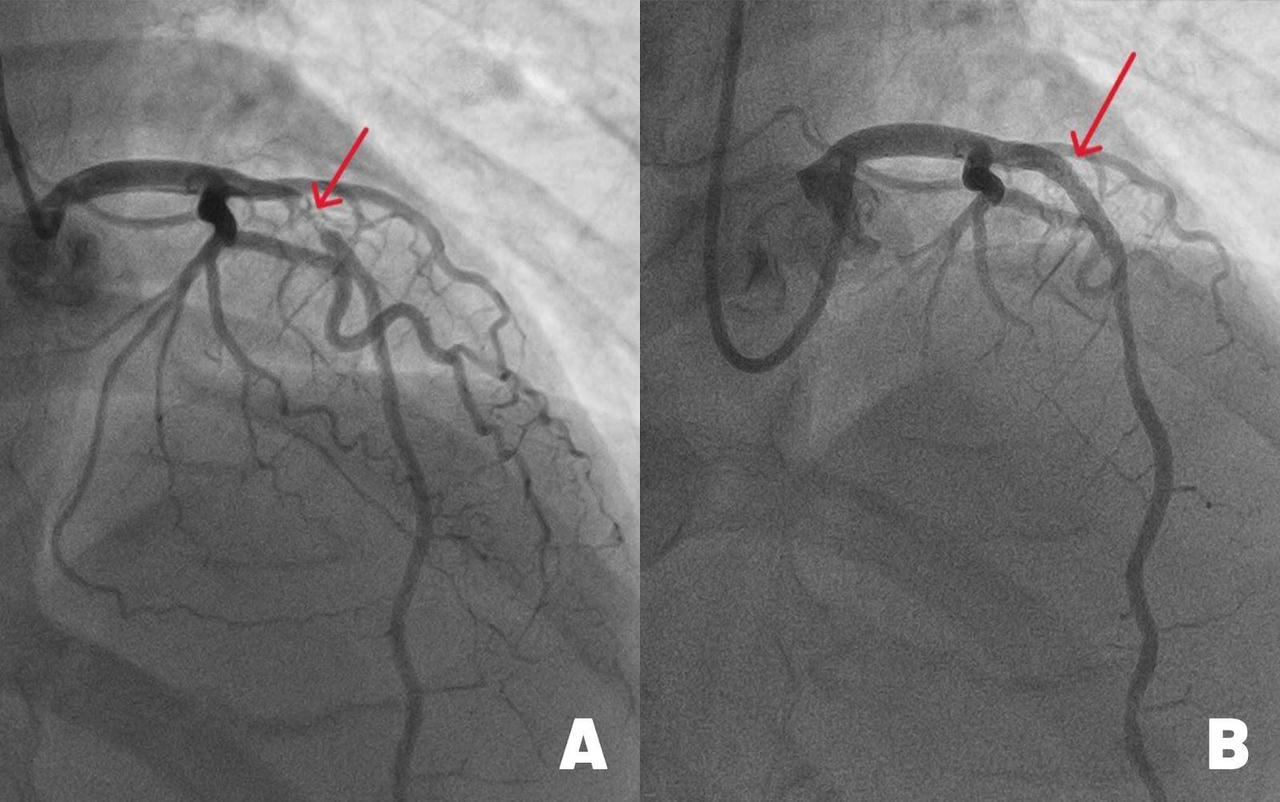 Nhập viện mổ ruột thừa phát hiện thiếu máu nuôi tim suýt đột tử