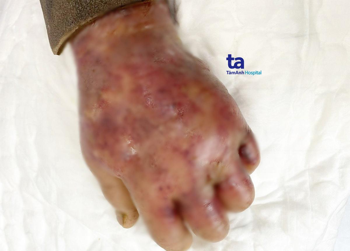 Giữ bàn tay lành lặn cho bệnh nhân tiểu đường