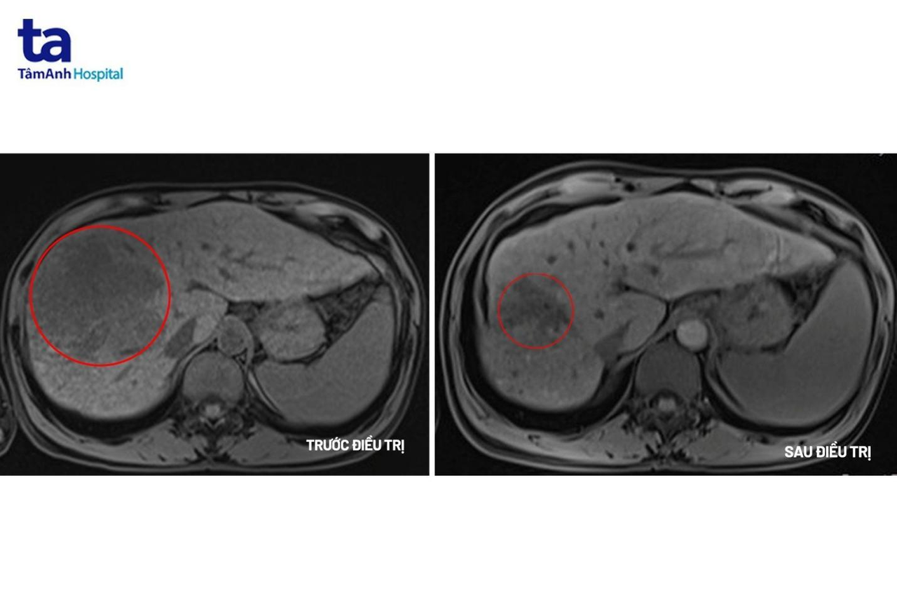 Đau tức hạ sườn đi khám phát hiện ung thư gan giai đoạn muộn