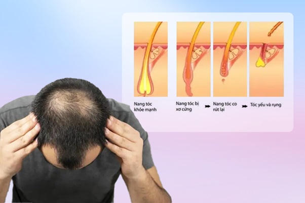 Rụng tóc hói đầu mất thẩm mỹ - Nỗi ám ảnh của bất kỳ ai 