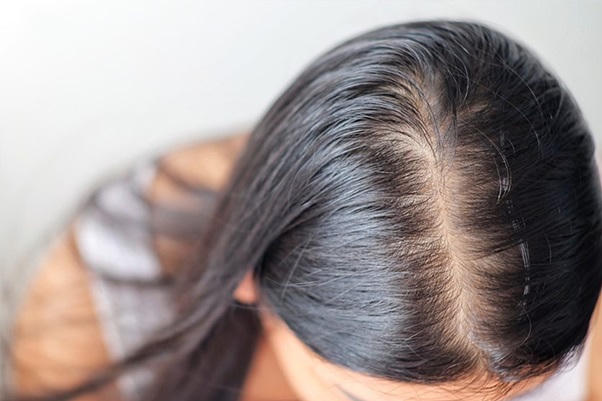 Rụng tóc hói đầu mất thẩm mỹ - Nỗi ám ảnh của bất kỳ ai 