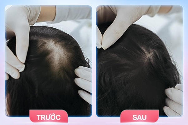 Rụng tóc hói đầu mất thẩm mỹ - Nỗi ám ảnh của bất kỳ ai 