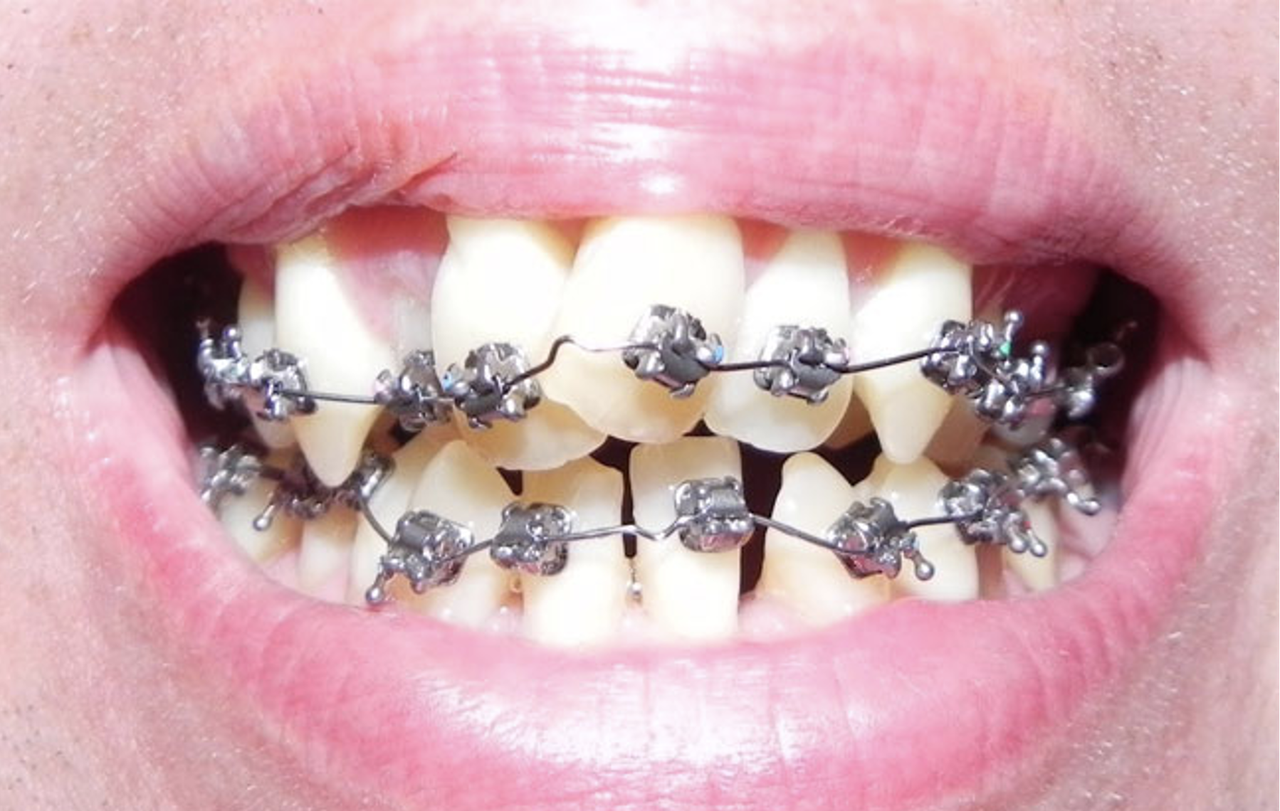 “Nha tặc” - Nỗi đau không của thiểu số