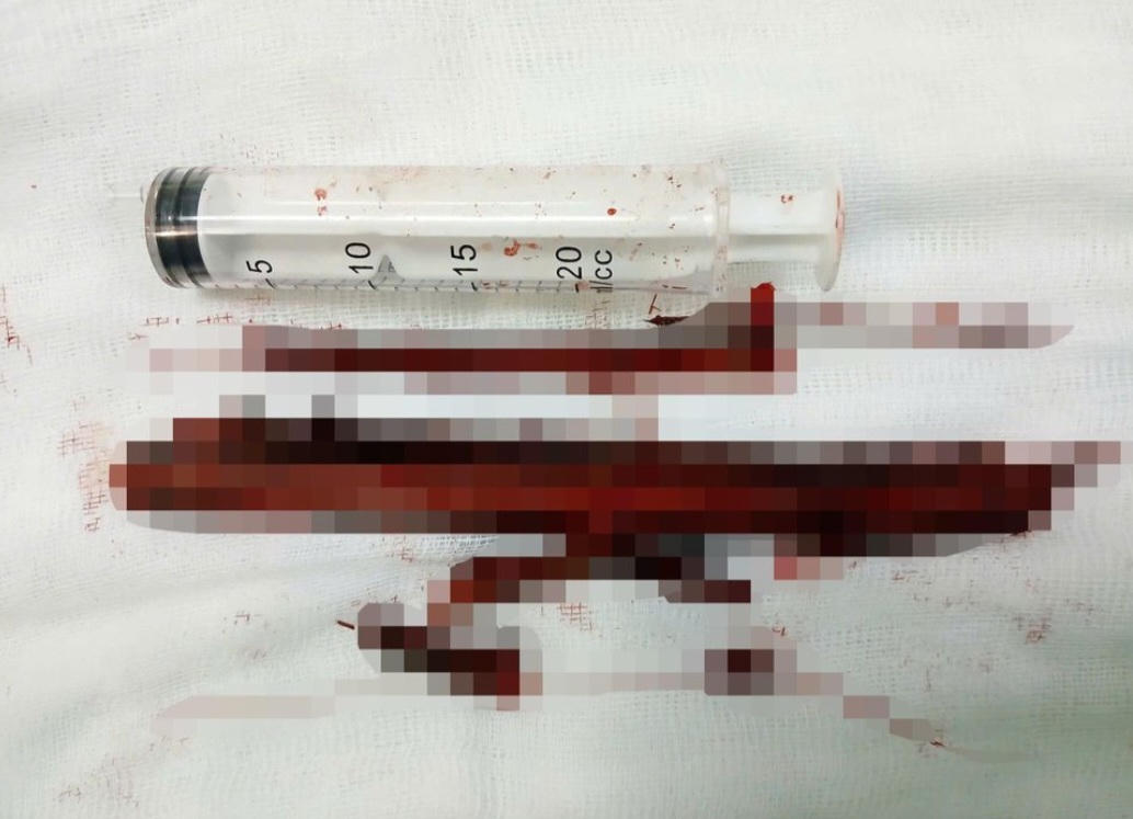 Hy hữu cụ bà 95 tuổi bị cành cây đâm vào lồng ngực 2 năm không hay biết