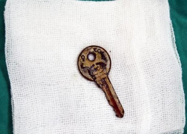 Gắp thành công chìa khóa rỉ mắc trong cổ họng bé 6 tuổi