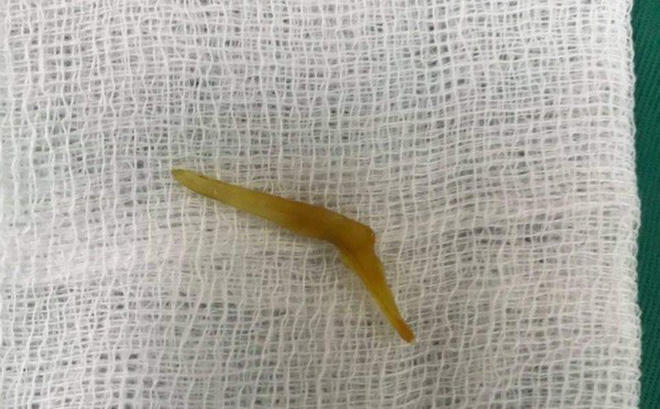 Nam thanh niên thủng ruột vì nuốt xương cá