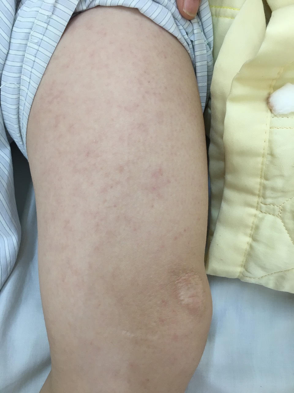 Nữ bệnh nhân biến chứng viêm não vì mắc sởi