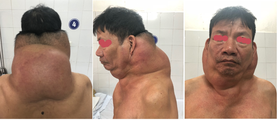 Phẫu thuật khối u khổng lồ cho 'người gấu'