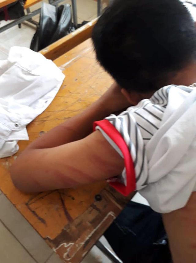 Điều tra vụ nam sinh lớp 8 bị bố đẻ đánh đập dã man 