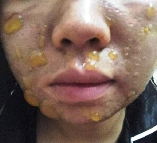 Cô gái sắp cưới bỏng mặt do lột da bằng 'mỹ phẩm axit'