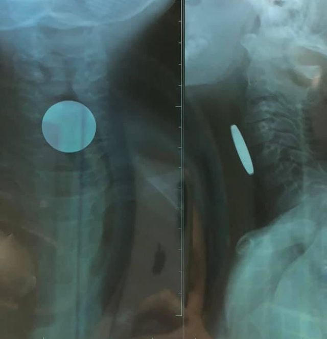 Bé trai 5 tuổi bị 'xèng' game mắc vào thực quản