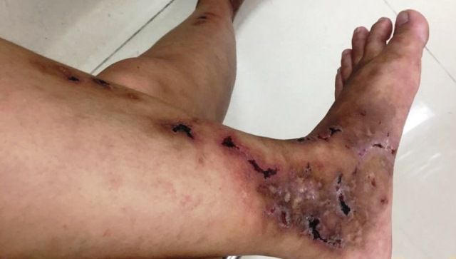 Nguy cơ cắt cụt chi, tháo khớp do bị viêm mao mạch dị ứng 