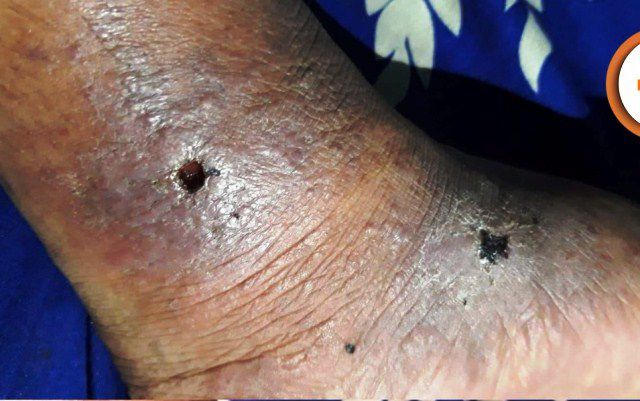 Nguy cơ cắt cụt chi, tháo khớp do bị viêm mao mạch dị ứng 