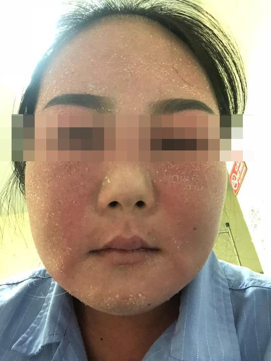 Sử dụng mỹ phẩm trắng da cô gái phải nhập viện cấp cứu